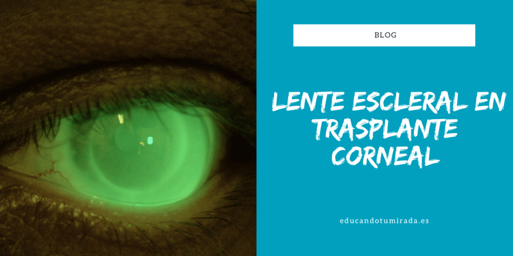 Lente escleral en trasplante corneal | Blog | en Educando tu mirada
