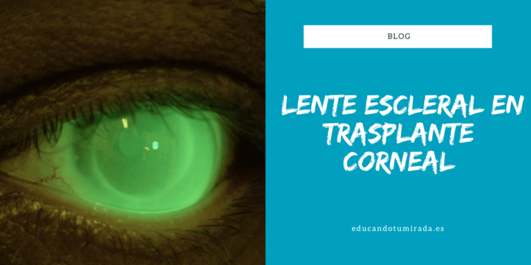 Lente escleral en trasplante corneal | Blog | en Educando tu mirada