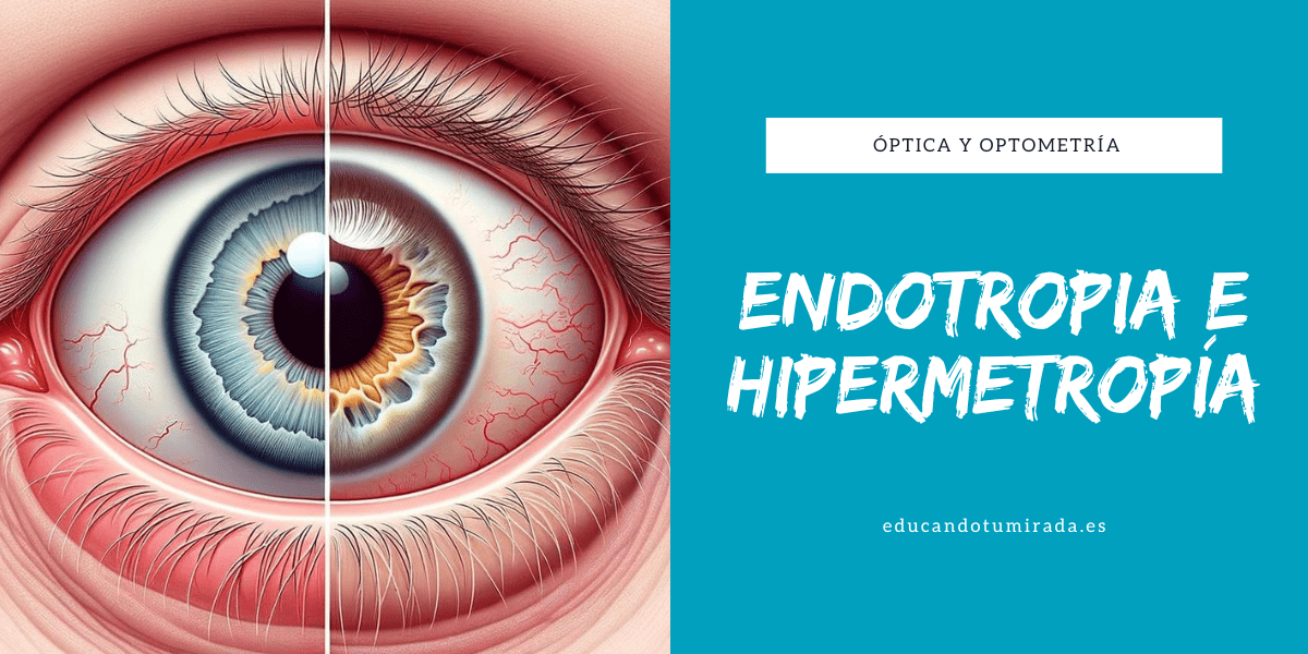 Endotropia e hipermetropía | Blog | en Educando tu mirada