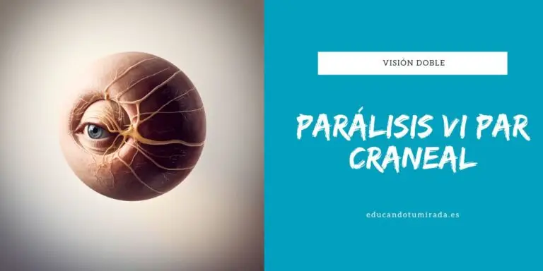 Parálisis del VI par craneal: una causa frecuente de visión doble